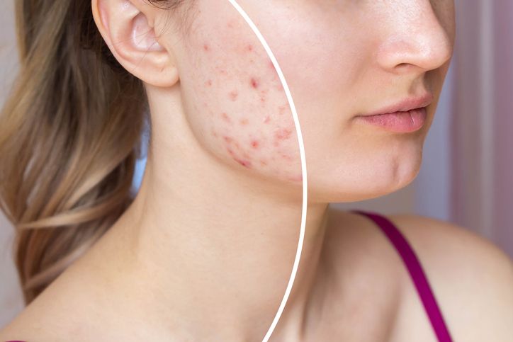 How to treat acne; what are the dos and don'ts?