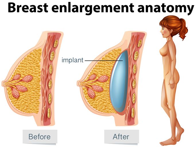 Enlarge your breast without implants!
