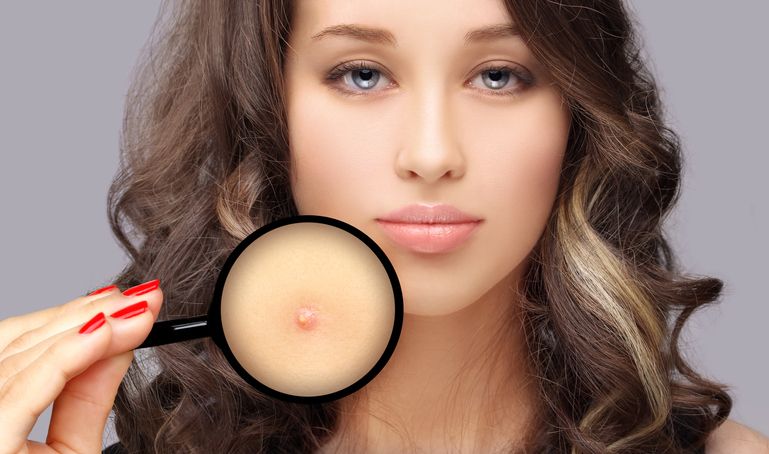 What Kills Acne Fast? The 10 Do’s & Don'ts To A Clear Skin