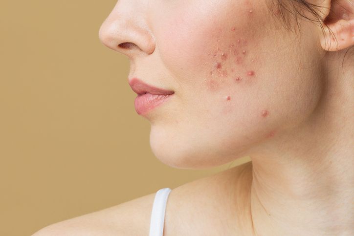 What Is Acne Trying to Tell You About Your Health and How to Remove Them?