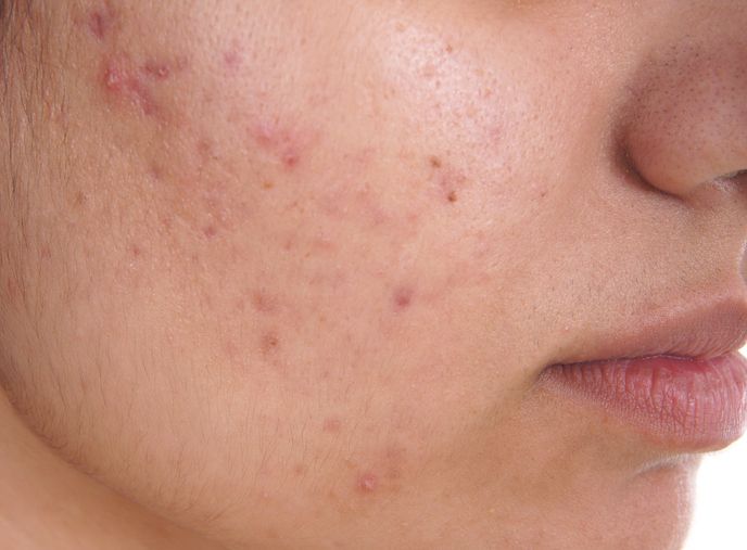 Can The Acne Treatment Help Remove Acne Scars?