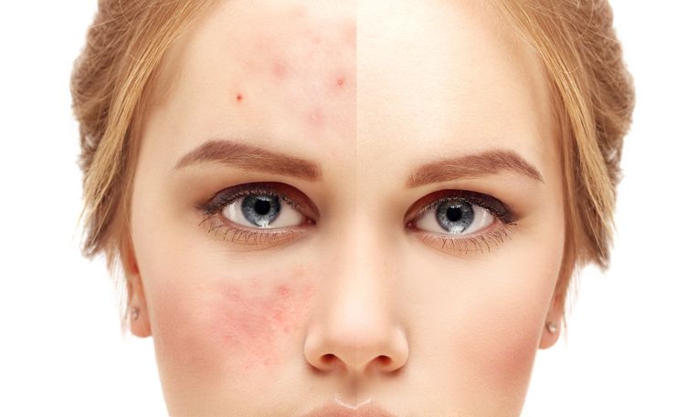 Fight Acne and Win: Treatments That Actually Work