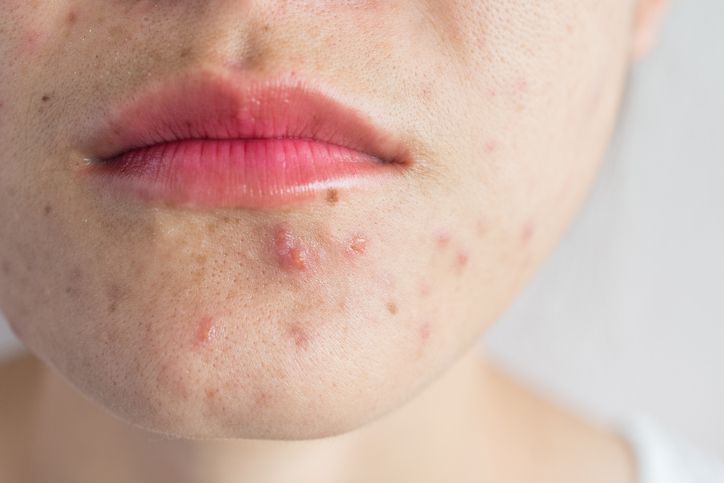 How To Treat Hormonal Acne with The Acne Treatment?