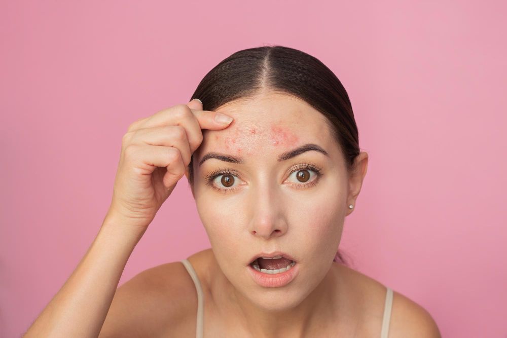 /uploads/acne_zones_1_fef9ebcd31.jpg