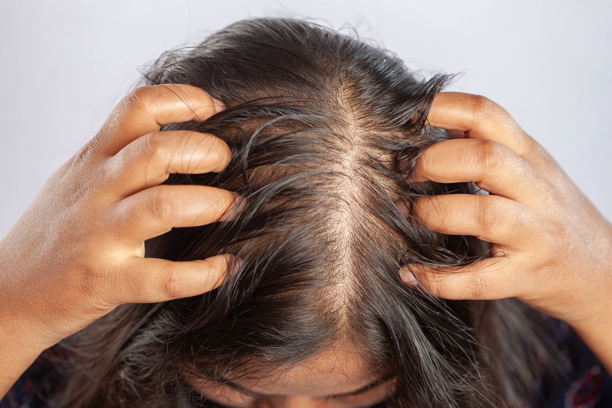 /uploads/bald_spot_on_head1_d626e57288.jpg