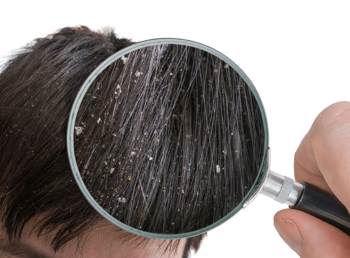 /uploads/dandruff_treatment1_fa94048fc7.jpg