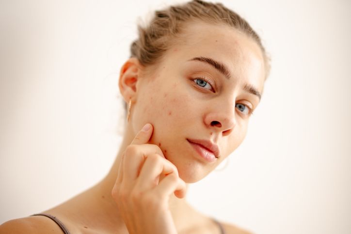 /uploads/different_types_of_acne_1_0bb8a6caf3.jpg