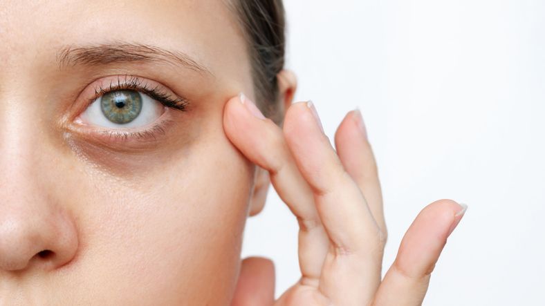 How To Remove Eye Bags and Dark Circles with The Miracle Eye Rescue Treatment?