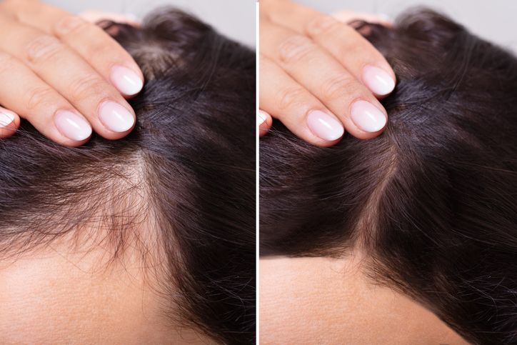 How Does the F8 Hair Regrowth Treatment Help Treat Receding Hairline?