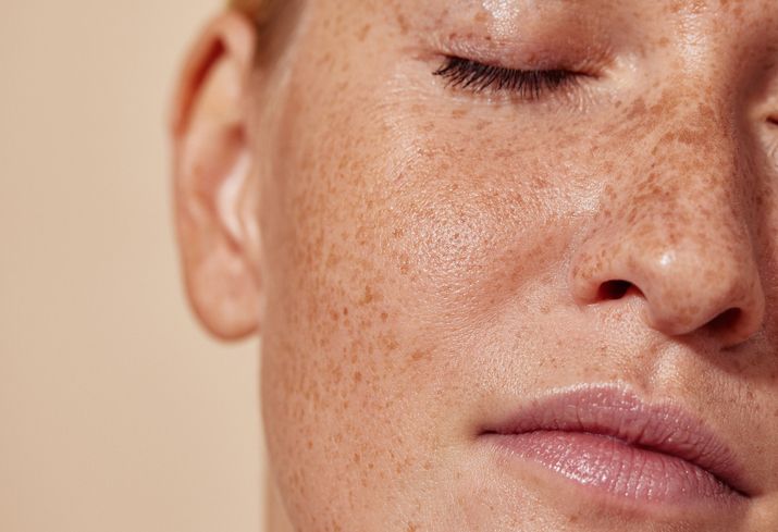 /uploads/how_to_lighten_freckles_on_face_1_3849f5fb6a.jpg
