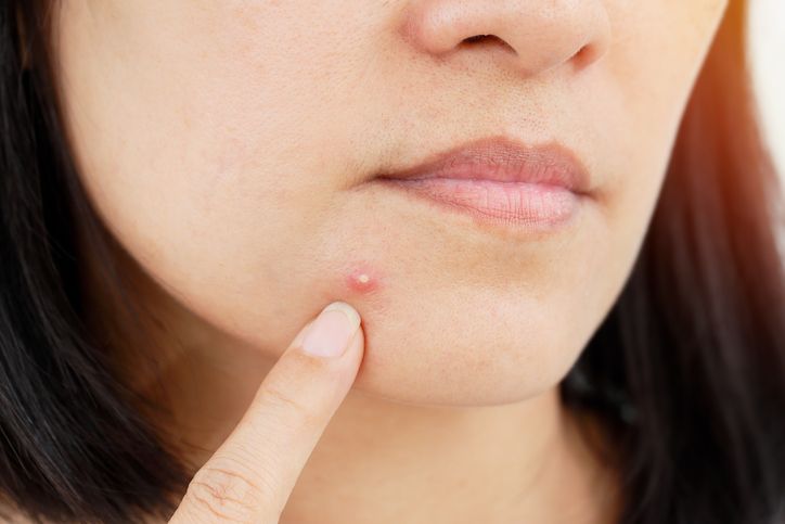 /uploads/how_to_shrink_acne_overnight_1_c256448e49.jpg