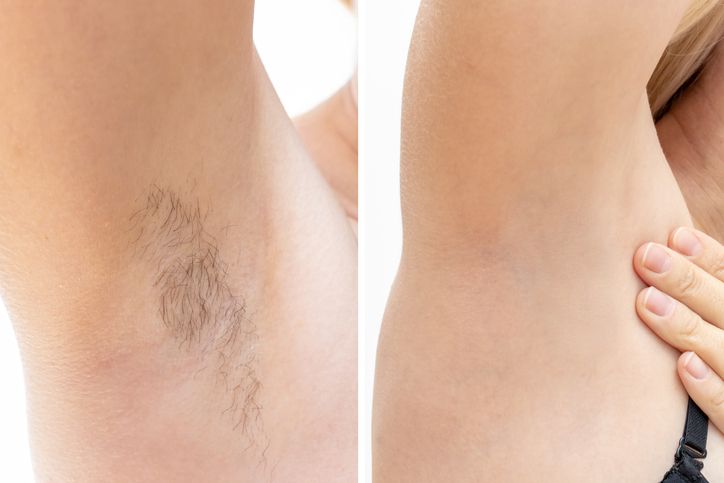 IPL Permanent Hair Removal - Is it for All Skin Types & Body ?