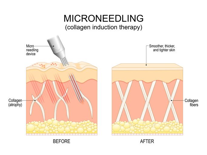/uploads/microneedling_for_acne_scars_1_158df4ebd0.jpg