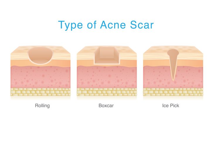 /uploads/pitted_acne_scars_1_707dba1aaf.jpg