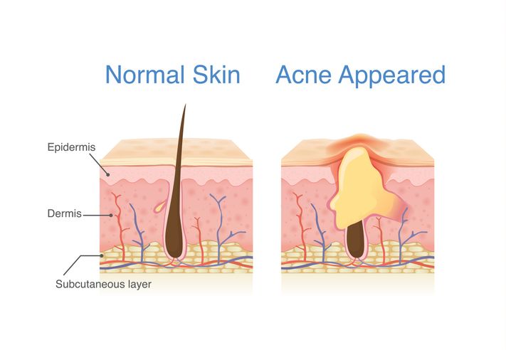How to Reduce Acne Without Harsh Treatments