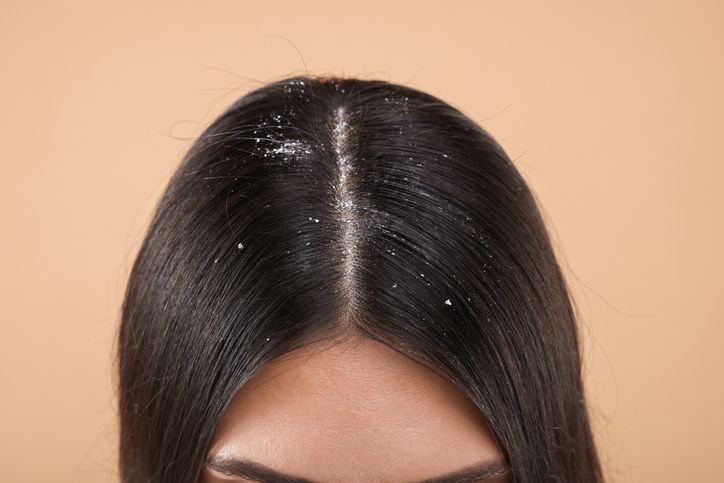 /uploads/scalp_buildup_vs_dandruff_1_68b7df6b08.jpg