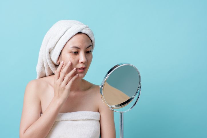 Find Out Now, What Should You Do Fast for Hyperpigmentation Acne
