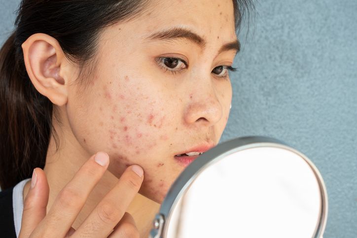 Top 5 products for acne prone skin!