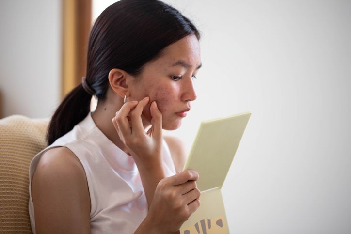 Pimple Treatment Guide: 6 Root Causes of Recurring Breakouts and How to Treat Acne Effectively