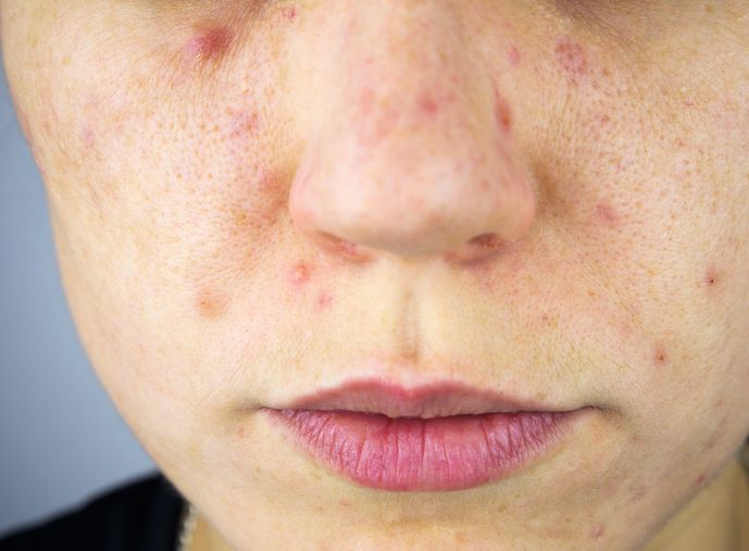 /uploads/why_is_my_skin_breaking_out_1_0ea581291c.jpg