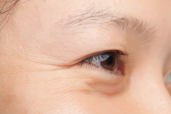 What Causes Wrinkles and How Does the Miracle Eye Rescue Treatment Help Treat This Issue?
