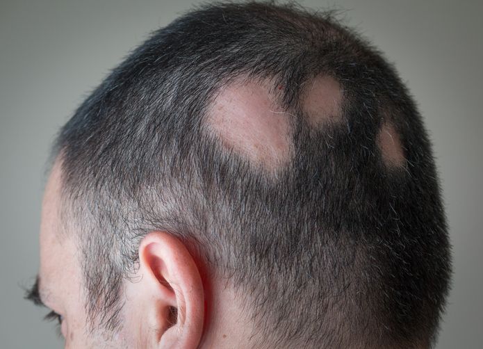 Can The F8 Hair Regrowth Treatment Help Individuals with Alopecia Areata?