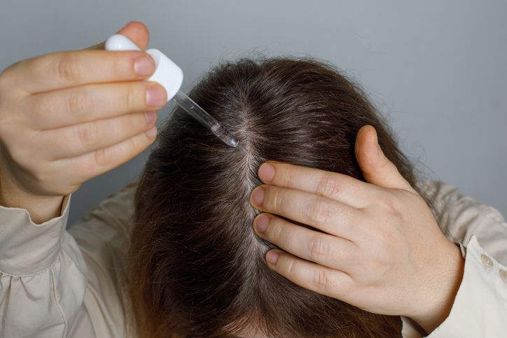 Does Minoxidil Work Without Side Effects? 5 Pros, Cons, and What to Expect Long-Term