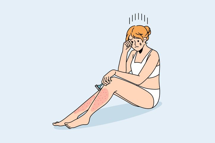 How to Treat Razor Burn and Post-Shave Irritation: Expert Tips for Soothing Skin and Preventing Razor Bumps