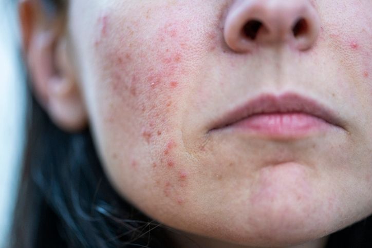 10 Ways to Treat a Red, Painful Zit on Your Face—Reduce Swelling, Unclog Pores, and Soothe Acne Fast