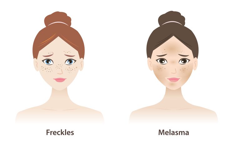 Building a Skin Routine to Minimize Discoloration